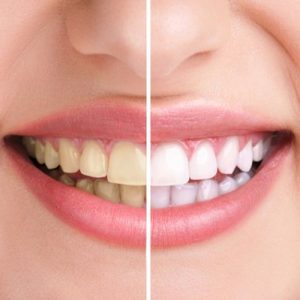 Ini Cara Menghilangkan Gigi Kuning dengan Bahan Alami yang Aman